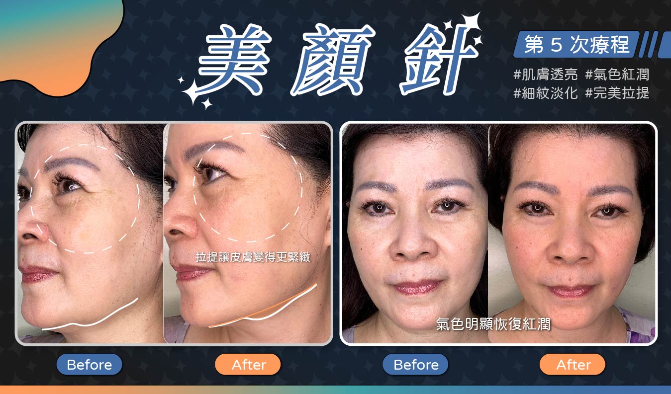 美顏針