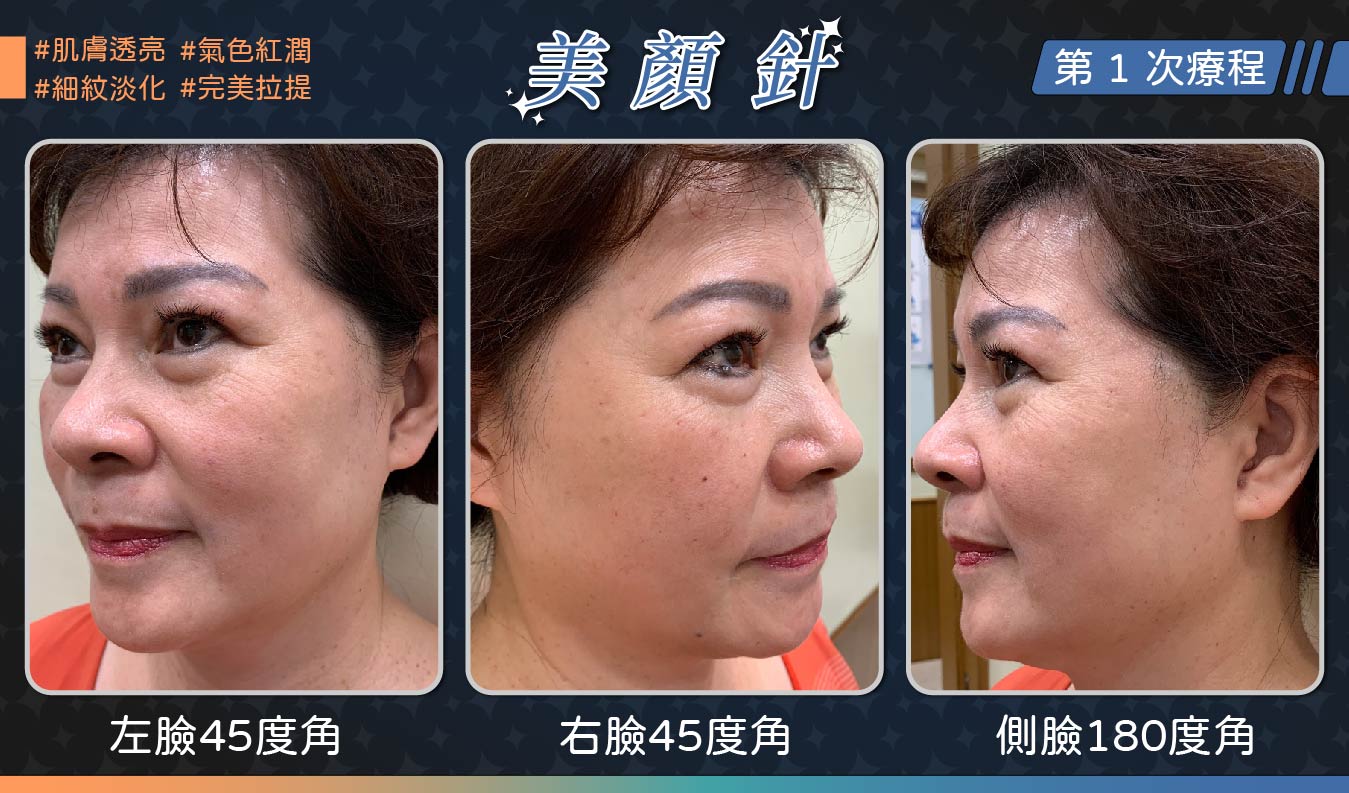 美顏針