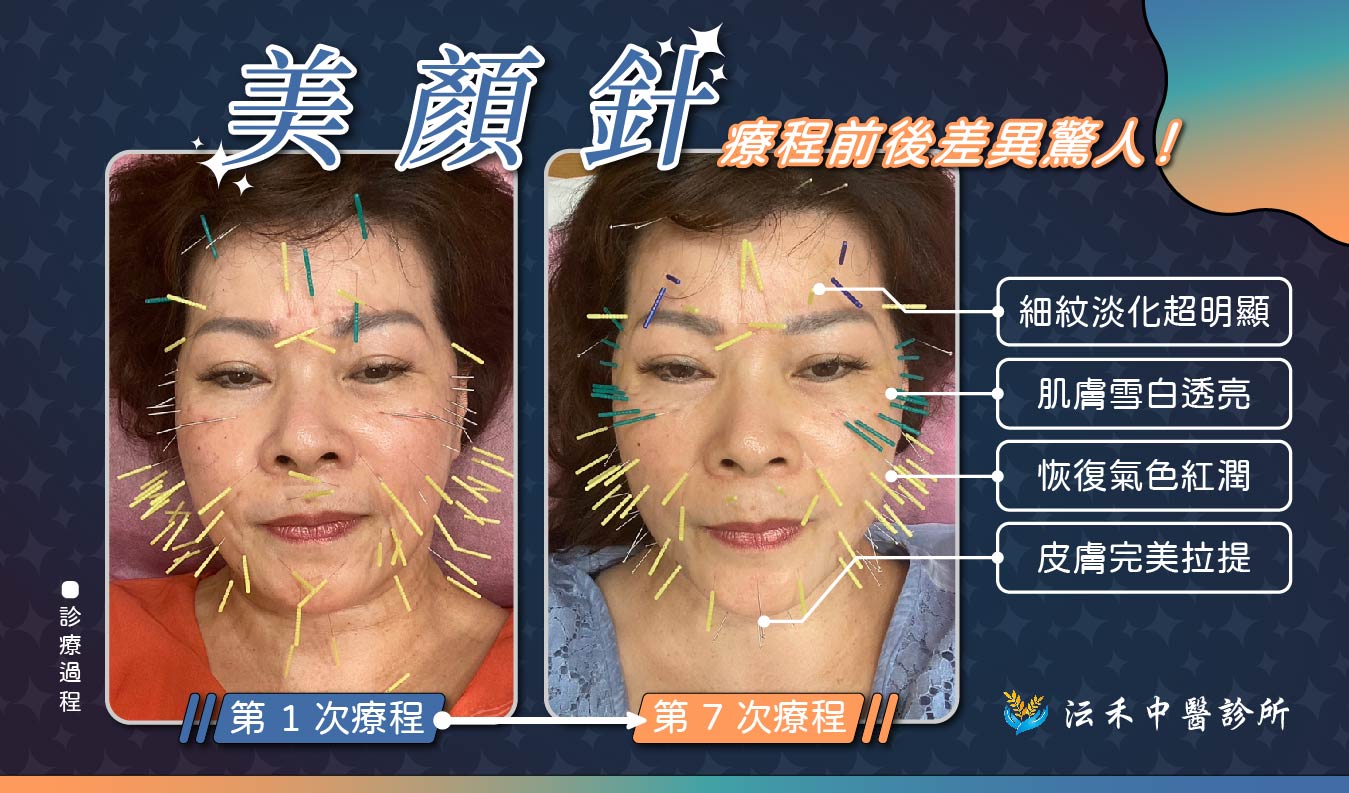 美顏針