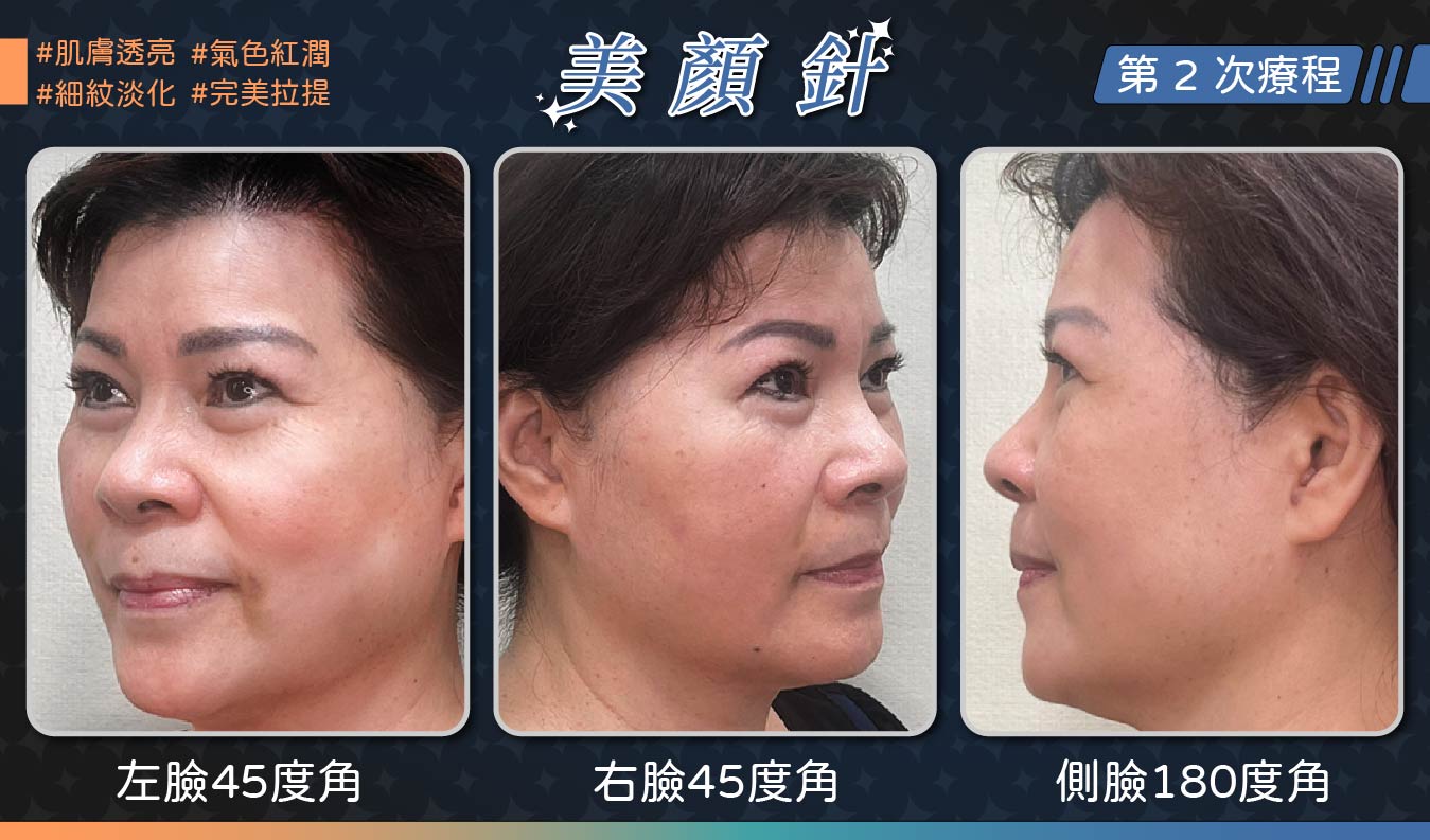 美顏針