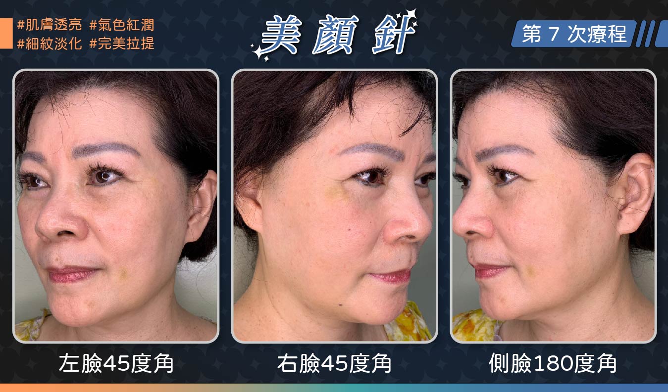 美顏針