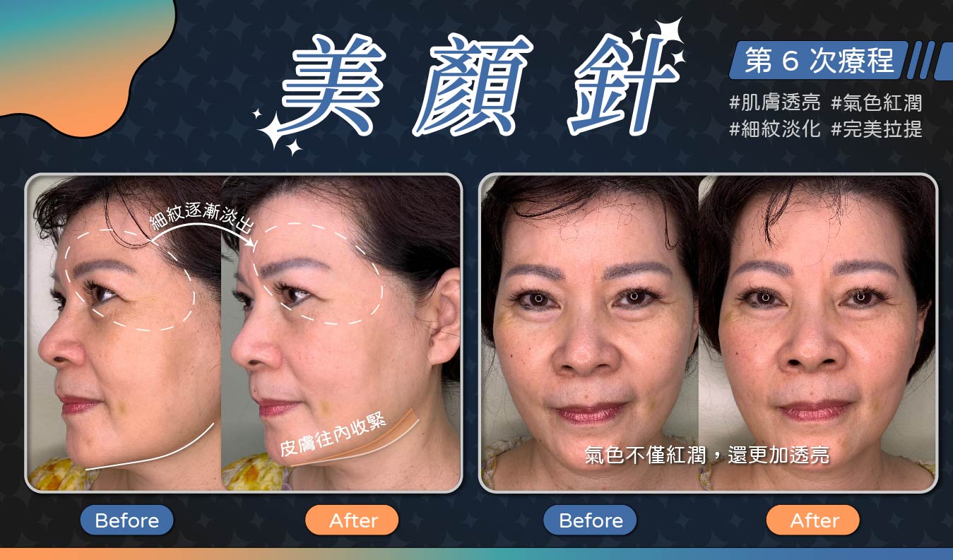 美顏針
