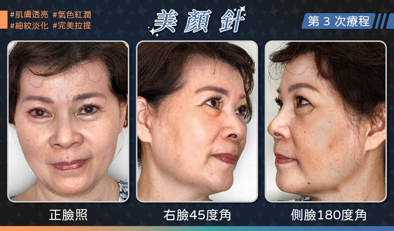 美顏針